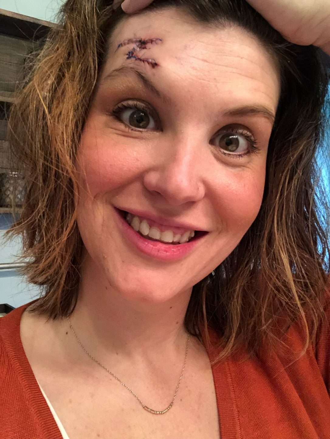 A few days after second procedure